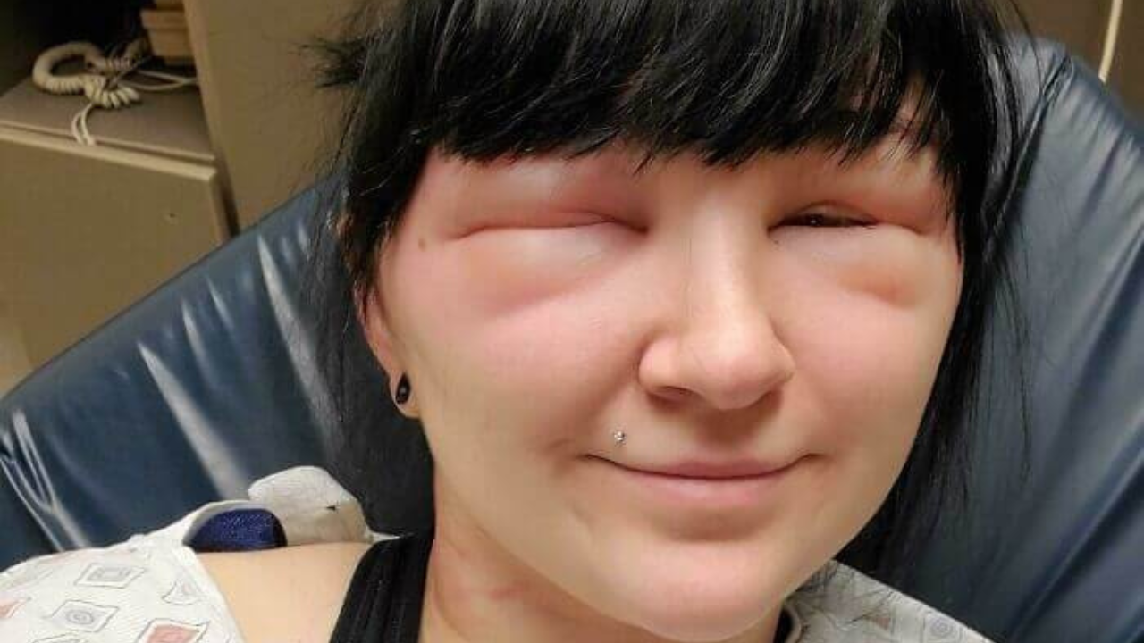 8. Another Painful Hair Dye Allergy Reaction