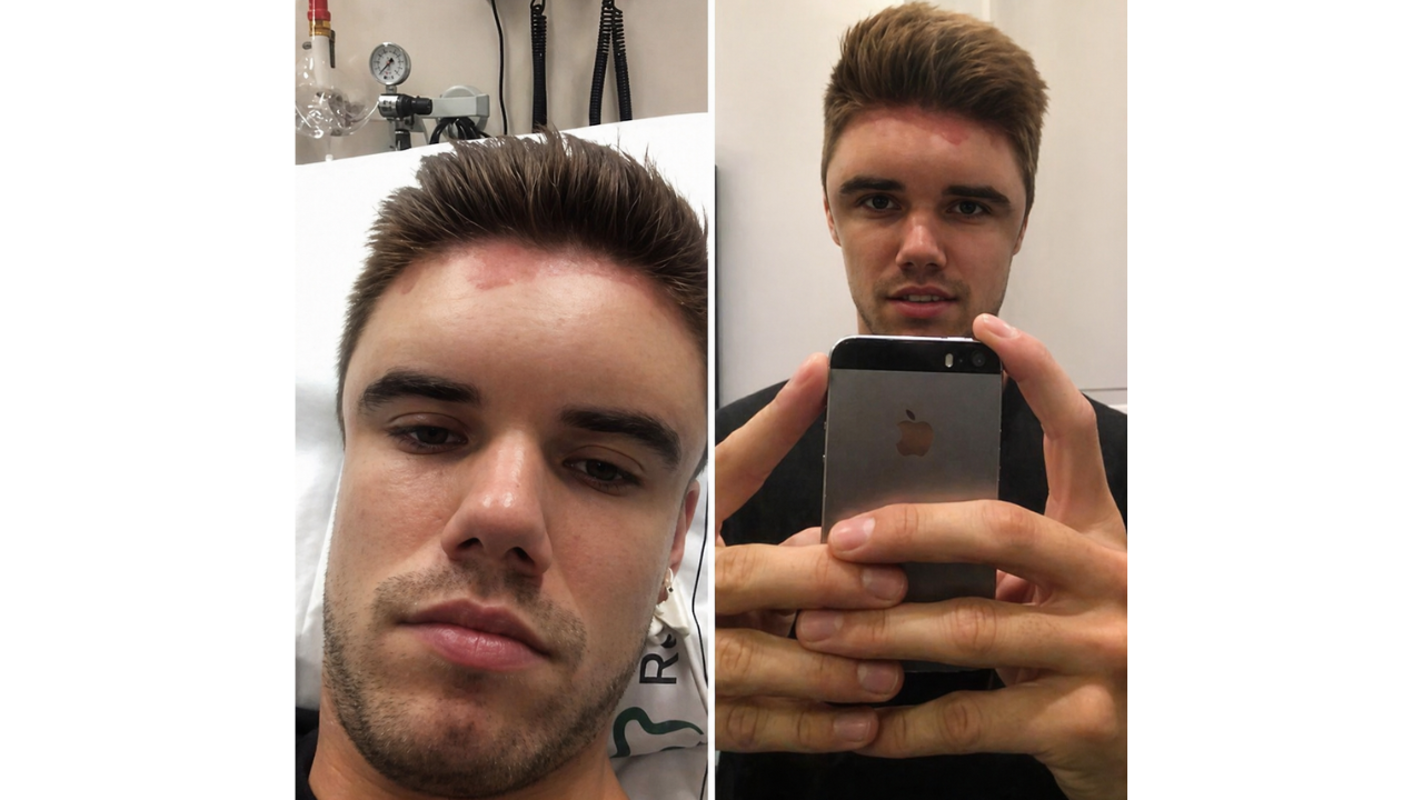 3. Discovering a Hair Dye Allergy Too Late