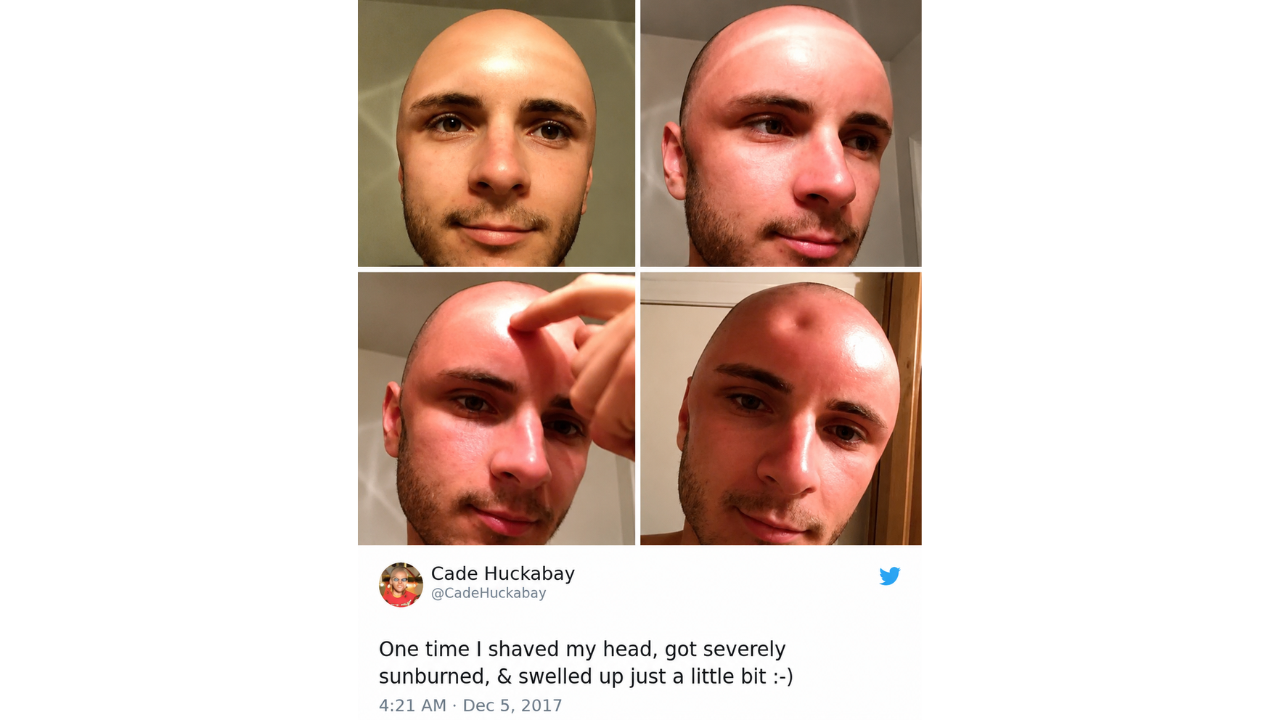 16. The Sunburn Nobody Could Ignore