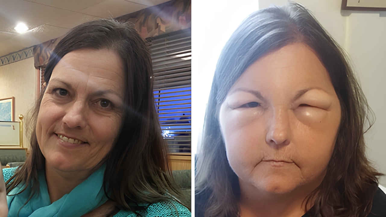 1. Yet Another Unexpected Dye Allergy